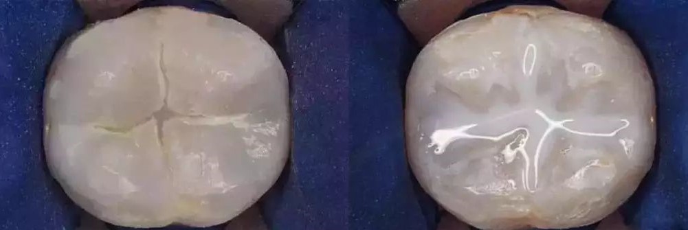 小孩牙齿上的黑色素能去掉吗？