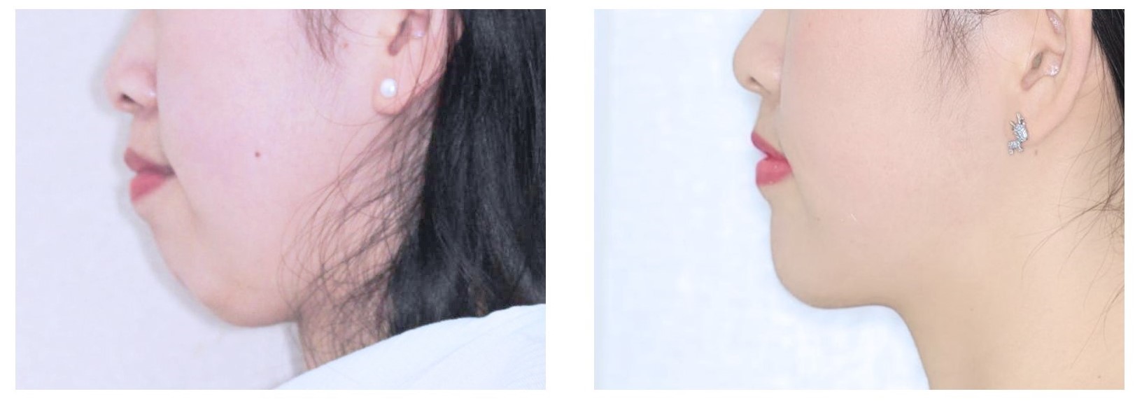 牙齿矫正为什么需要两年时间，能缩短吗？—义乌傅氏口腔