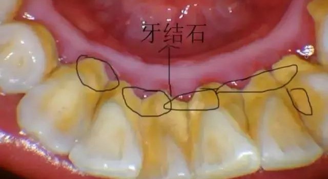 洗牙后牙齿酸软怎么回事？—义乌口腔护理