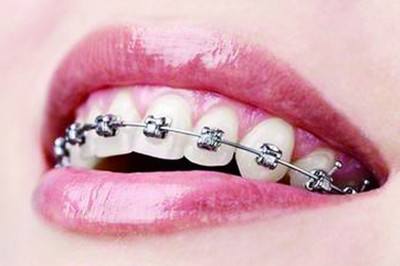 牙齿矫正疼不疼？—义乌傅氏口腔