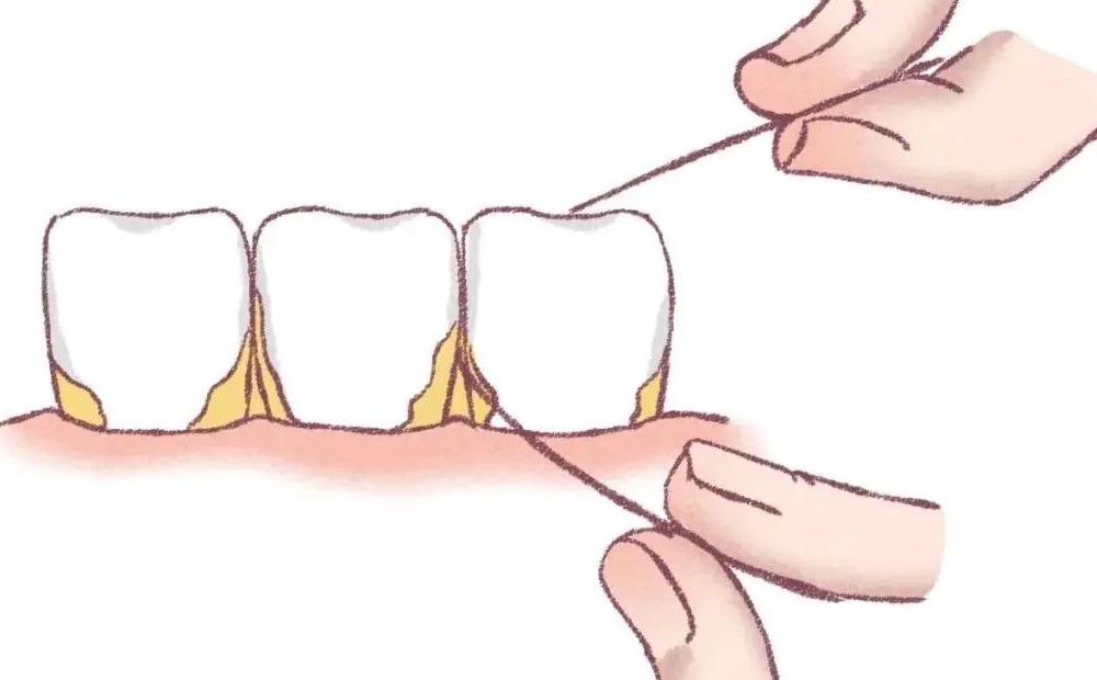 还在用牙签剔牙小心牙缝变宽! 还在用牙签剔牙小心牙缝变宽!