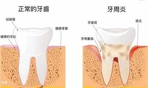 糖尿病、高血压患者，就不能做种植牙吗？—义乌傅氏口腔