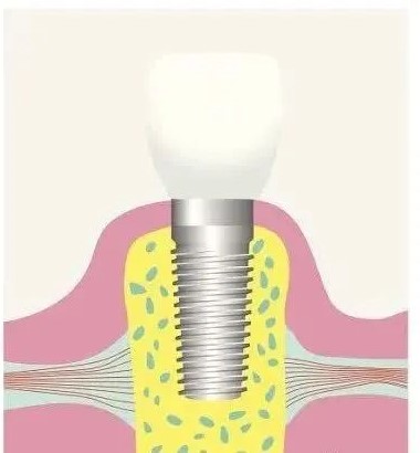 糖尿病、高血压患者，就不能做种植牙吗？—义乌傅氏口腔