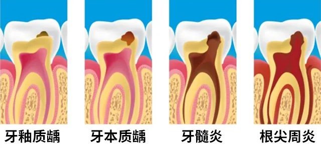 疼到无法入睡的牙髓炎该怎么办？