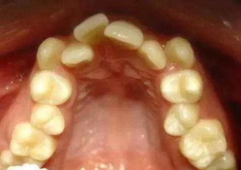 牙齿推挤不适,为何不尝试牙齿矫正呢?—义乌傅氏口腔 牙齿推挤不适,为何不尝试牙齿矫正呢?—义乌傅氏口腔