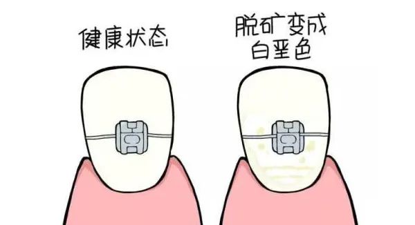 什么是牙齿脱矿？—义乌傅氏口腔