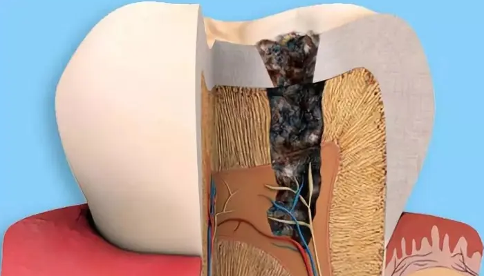 什么是牙齿脱矿？—义乌傅氏口腔