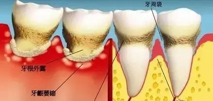为何要定期洗牙？