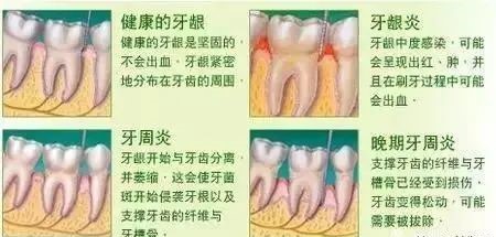 为何要定期洗牙？