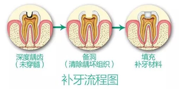 为何补牙一定要趁早？