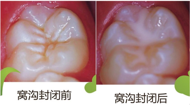 窝沟封闭防龋病,给牙穿上保护衣-义乌傅氏口腔 窝沟封闭防龋病,给牙穿上保护衣-义乌傅氏口腔