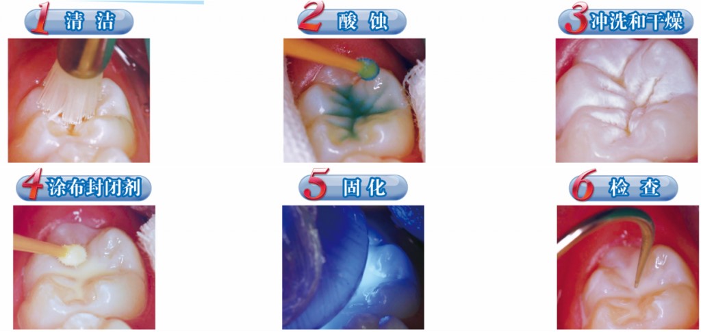 窝沟封闭防龋病,给牙穿上保护衣-义乌傅氏口腔 窝沟封闭防龋病,给牙穿上保护衣-义乌傅氏口腔