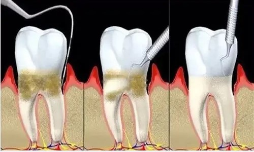 牙龈萎缩了能再恢复吗？