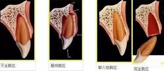 牙齿外伤脱落的黄金抢救时间! 牙齿外伤脱落的黄金抢救时间!