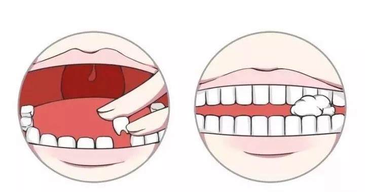 牙齿外伤脱落的黄金抢救时间! 牙齿外伤脱落的黄金抢救时间!