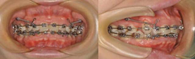 龅牙嘴突牙齿矫正后效果惊人！—义乌傅氏口腔