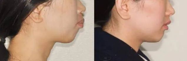 龅牙嘴突牙齿矫正后效果惊人！—义乌傅氏口腔