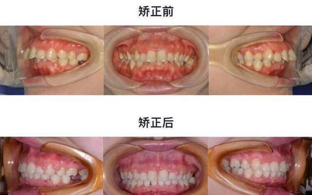 龅牙嘴突牙齿矫正后效果惊人！—义乌傅氏口腔