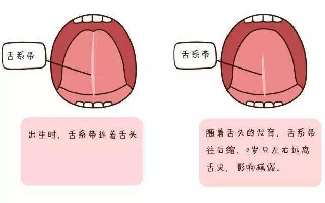 宝宝说话不清，不一定是舌系带的锅！—义乌傅氏口腔