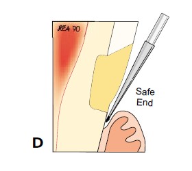 楔状缺损的应急对策！