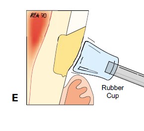 楔状缺损的应急对策！
