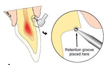 楔状缺损的应急对策！