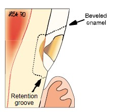 楔状缺损的应急对策！