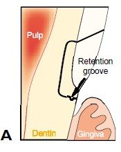 楔状缺损的应急对策！