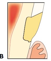 楔状缺损的应急对策！