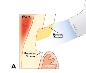 楔状缺损的应急对策！