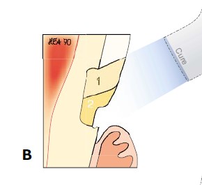 楔状缺损的应急对策！