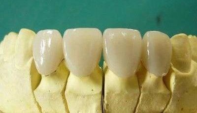 为何镶颗牙要磨两边的牙齿? 为何镶颗牙要磨两边的牙齿?