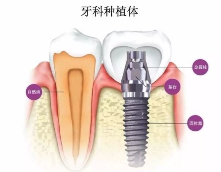 为何镶颗牙要磨两边的牙齿? 为何镶颗牙要磨两边的牙齿?