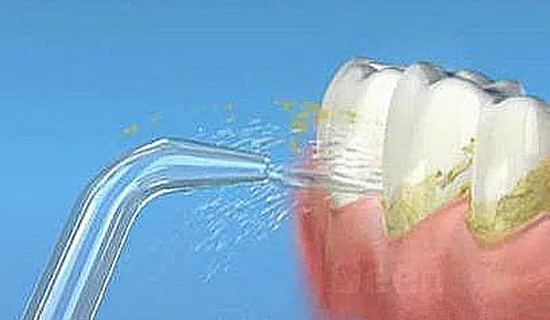 为何洗牙洗掉了牙结石，会觉得牙齿松动了？—义乌傅氏口腔