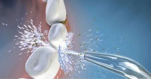 洗牙好吗,四种洗牙方式你适合哪种?—义乌傅氏口腔 洗牙好吗,四种洗牙方式你适合哪种?—义乌傅氏口腔