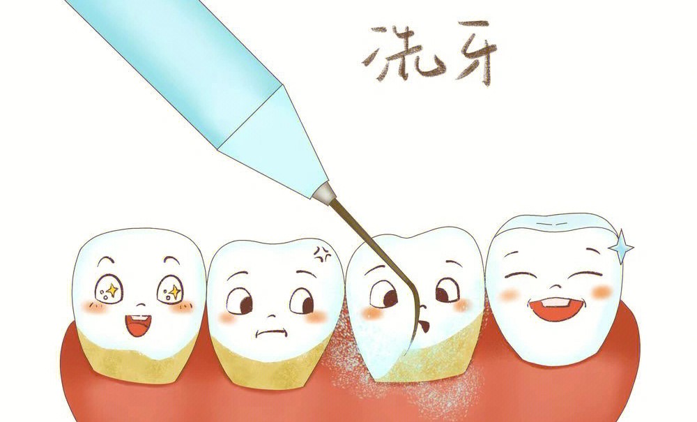 刷牙总出血要不要去洗牙？—义乌口腔护理