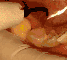 洗牙是投资回报率高的一件事! 洗牙是投资回报率高的一件事!