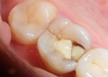 牙齿掉了一小块是怎么回事？—义乌口腔护理