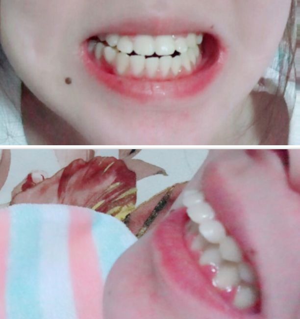 牙齿矫正时选错了医生的后果！—义乌傅氏口腔