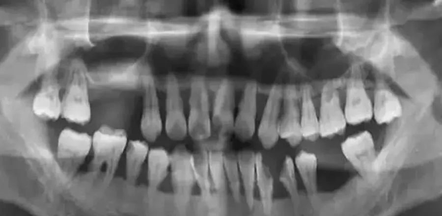 牙周病不可怕，怕的是你得牙周病都不知道！—义乌傅氏口腔