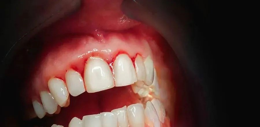 牙周病不可怕，怕的是你得牙周病都不知道！—义乌傅氏口腔