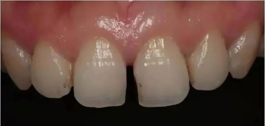 牙周病不可怕，怕的是你得牙周病都不知道！—义乌傅氏口腔