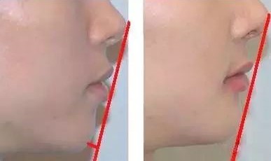 左图下颌后缩,上颌前突/右图为正常下巴。 左图下颌后缩,上颌前突/右图为正常下巴。