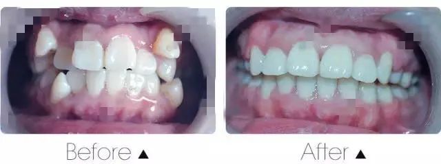 牙齿不齐要做牙齿矫正吗?—义乌傅氏口腔 牙齿不齐要做牙齿矫正吗?—义乌傅氏口腔