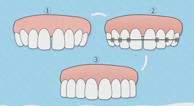 这几种牙齿类型,牙齿矫正越早难度越小!—义乌傅氏口腔 这几种牙齿类型,牙齿矫正越早难度越小!—义乌傅氏口腔