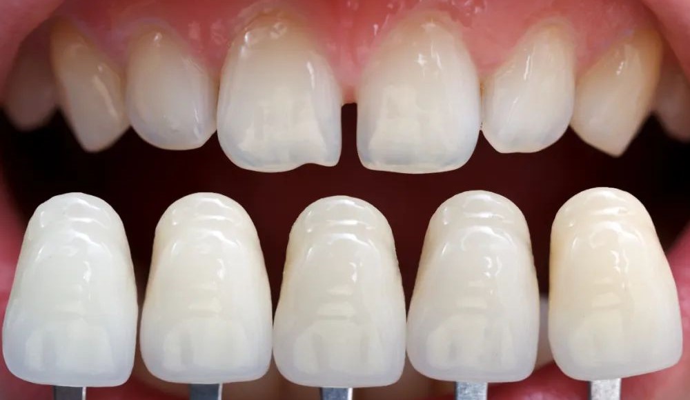 牙缝过大的处理方法及注意事项！—义乌傅氏口腔