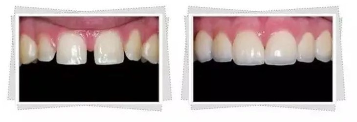 牙缝过大的处理方法及注意事项！—义乌傅氏口腔