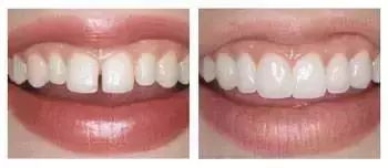 为何牙缝越来越大,该怎么办?—义乌傅氏口腔 为何牙缝越来越大,该怎么办?—义乌傅氏口腔