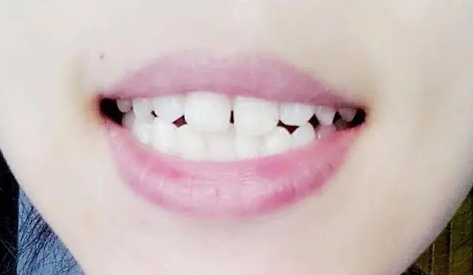 牙缝大真的太丑了！还有救吗？