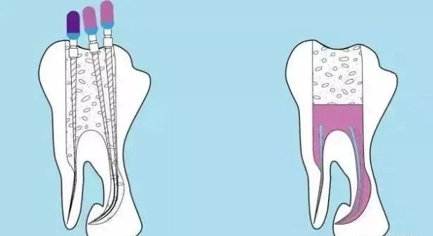 牙医让戴牙冠，真的是为你的牙齿着想！—义乌傅氏口腔